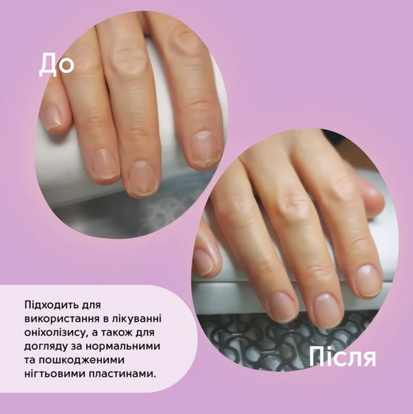 Shelly Олія при пошкодженні нігтьової пластини Стоп Оніхолізис 30 мл 70907 фото